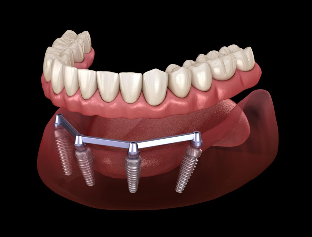 Embracing Digital Dentistry: How 3D Printing Revolutionises Dental Implants