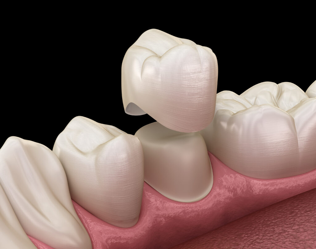 Dental Crowns Houston