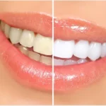 The Influence of Music on Teeth Whitening Success