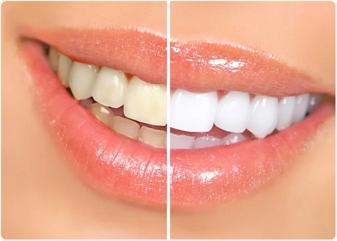 The Influence of Music on Teeth Whitening Success